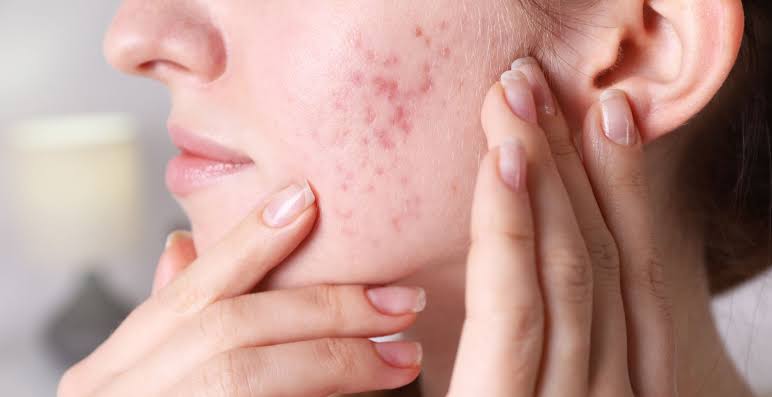 Hormonal Acne Exposé: The Unexpected Face of Adult Skin Struggles